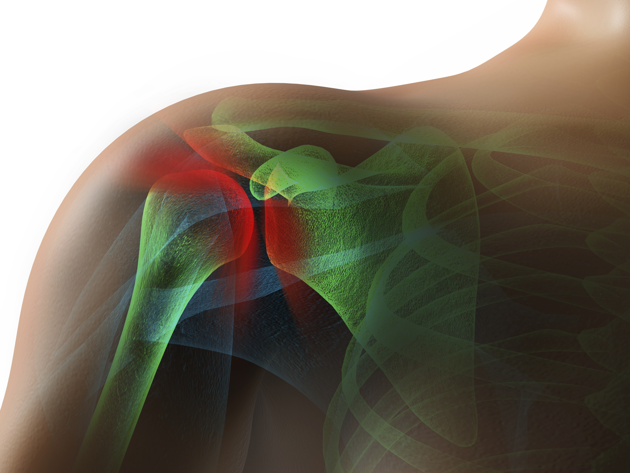 Améliorer l’évaluation et le traitement des lésions professionnelles de l’épaule